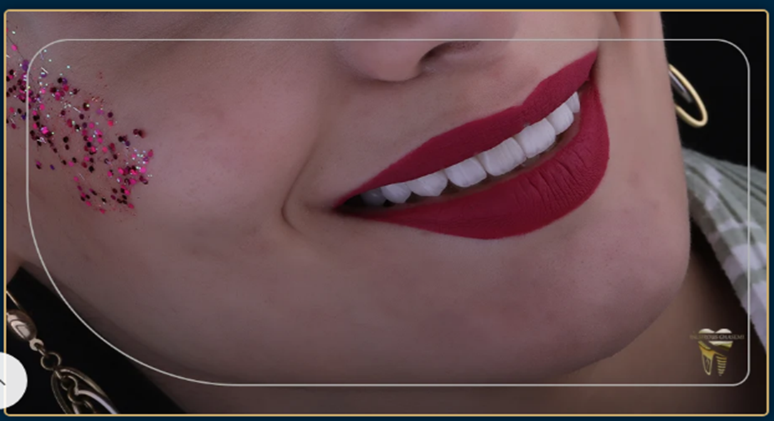 صفر تا صد فرایند دندانپزشکی دیجیتال برای لمینت دندان در بهترین مطب دندانپزشکی شیراز