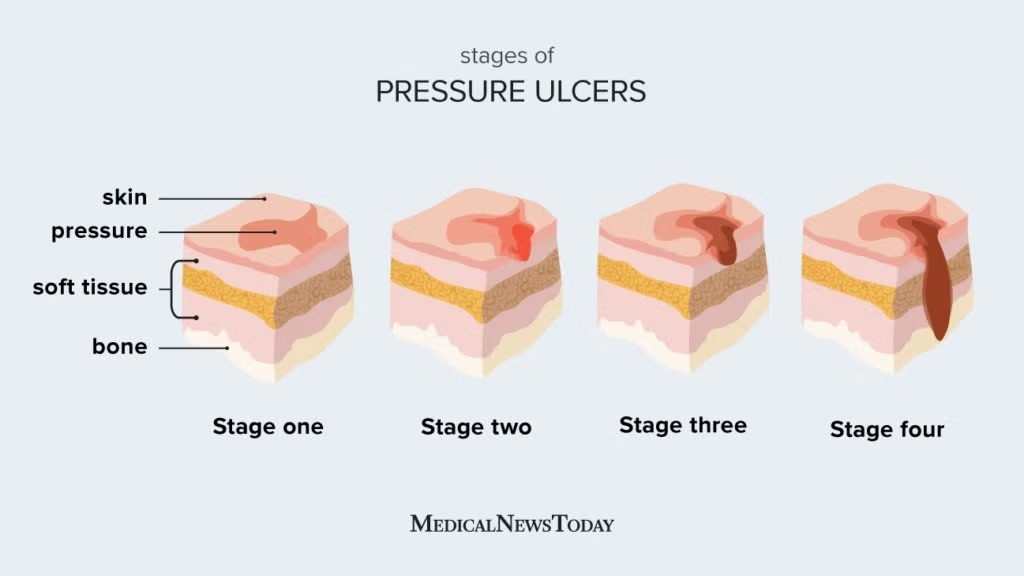 آشنایی با روش‌های درمان زخم بستر در منزل