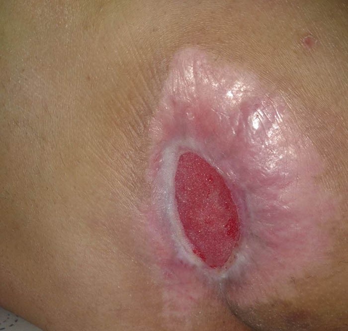 آشنایی با روش های درمان زخم بستر در منز