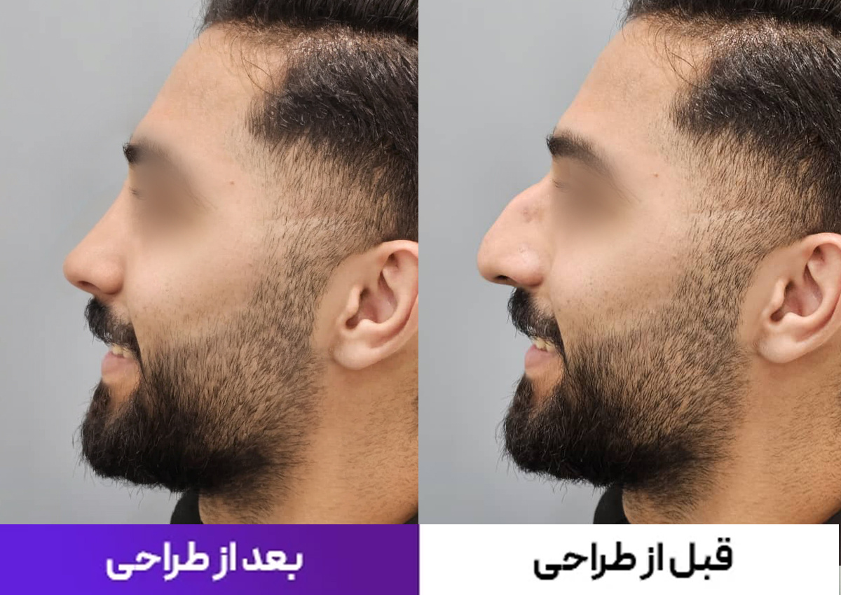 جراحی بینی در تهران با پزشک ۲۴